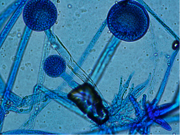 Rhizopus fungal elements seen on staining of pathology specimen