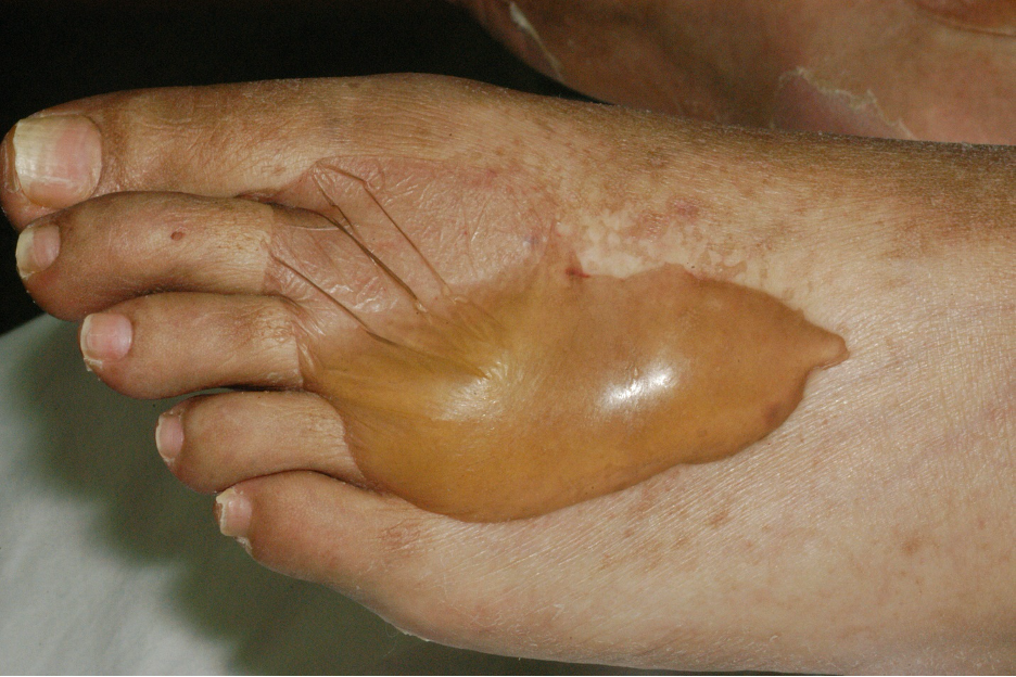 Bulla on the dorsum of the left foot
