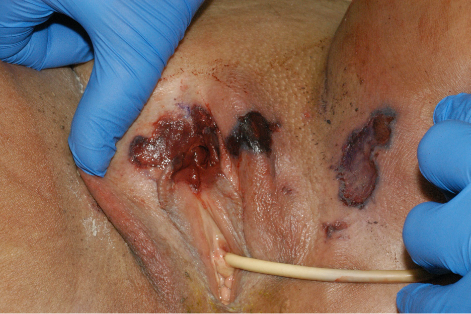 Subepithelial hemorrhage involving the labia minora and majora and ulceration on inner thigh