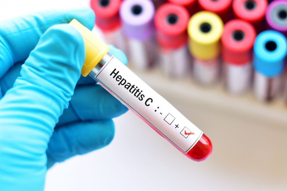 Is universal HCV screening in pregnant women cost-effective?
