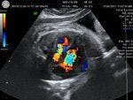 DailyDx: Fetus Presenting with Cardiomegaly