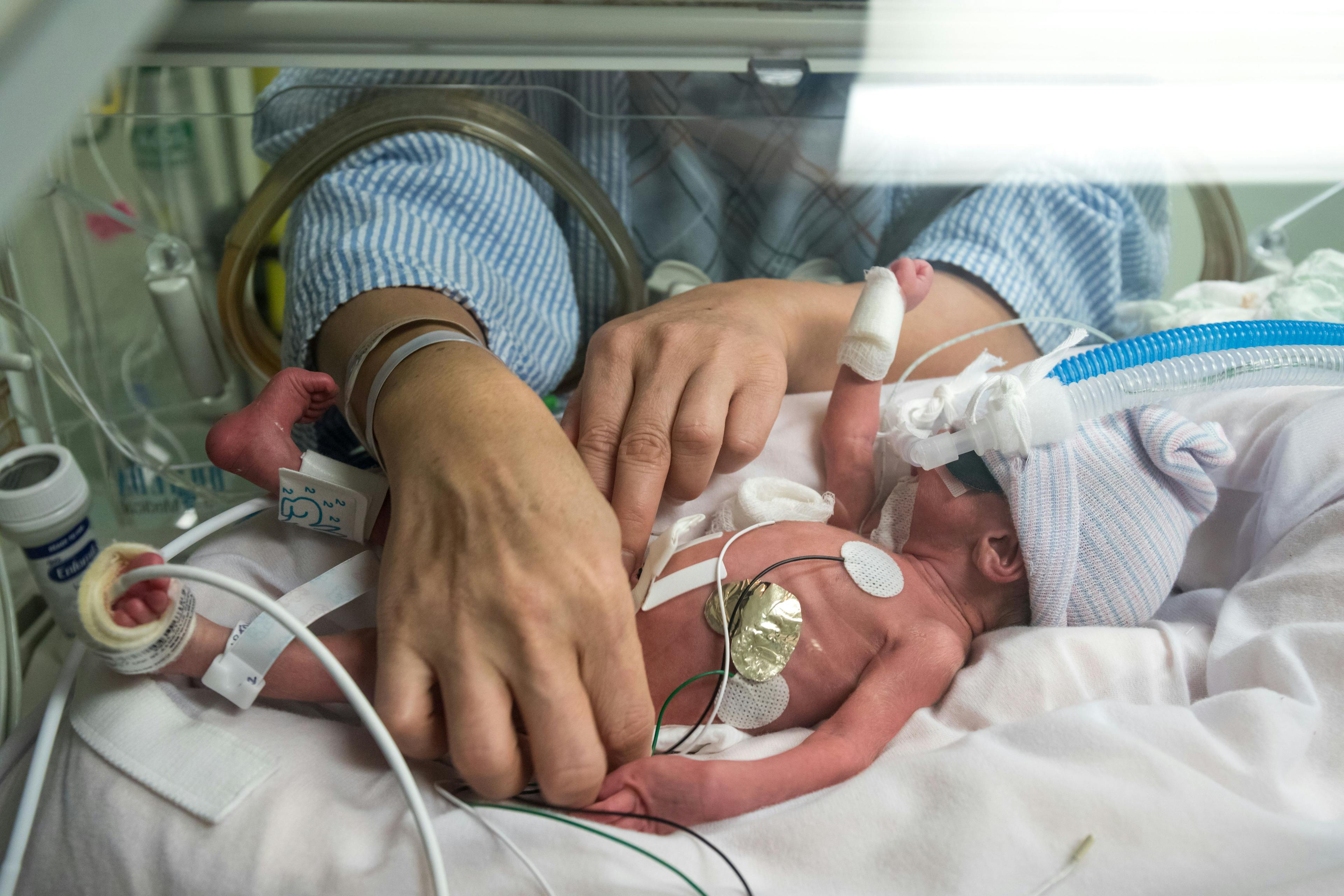 Low birth weight associated with attention problems in children