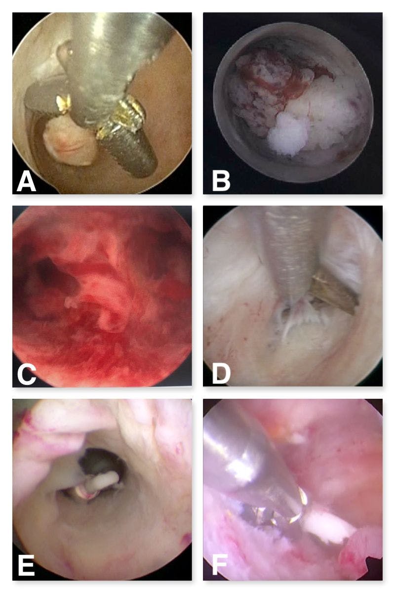 Hysteroscopic images of various intrauterine pathology taken in the office. (A) Grasping a small intrauterine polyp. (B) A focal endometrial cancer missed by endometrial biopsy. (C) Uterine septum. (D) Lysis of adhesions in the lower uterine segment. (E) A retained IUD with previously avulsed strings. (F) A grasper removing an embedded IUD arm.