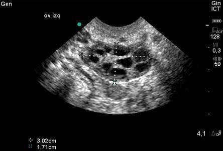 Polycystic ovary, transvaginal ultrasound 3th day of period clinical signs of insulin resistance