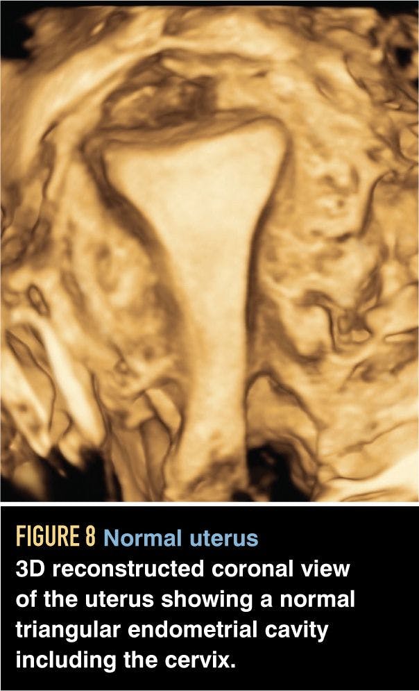 Normal uterus