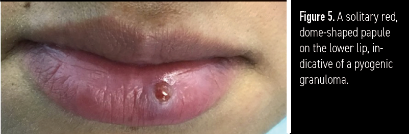 Figure 5. A solitary red, dome-shaped papule on the lower lip, indicative of a pyogenic granuloma.