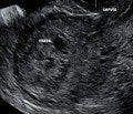 Postabortal Placental Polyp or Uterine AVM? Saline Instillation Sonohysterography as a Diagnostic Aid
