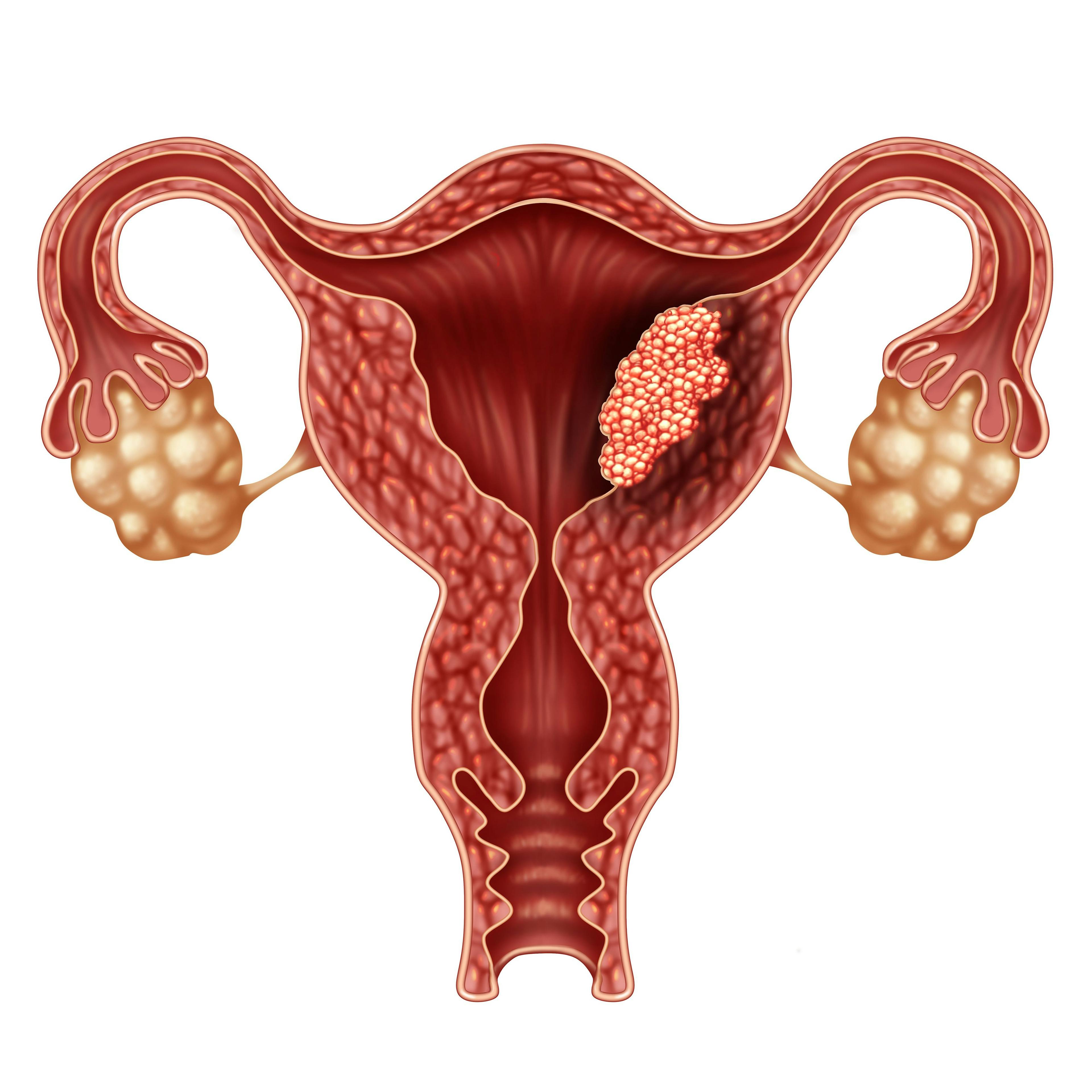  Immunotherapy approvals shine light on need for molecular testing in endometrial cancer