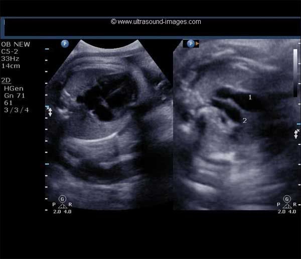 Daily Dx: Three-Vessel View of a Fetal Heart