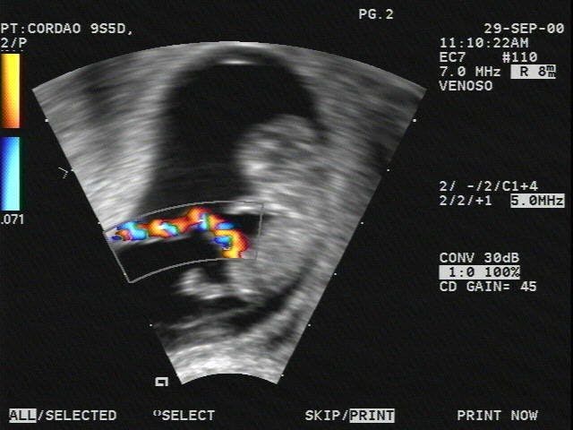 LONG Fetus (Transvaginal) Umbilical Cord on Color Doppler