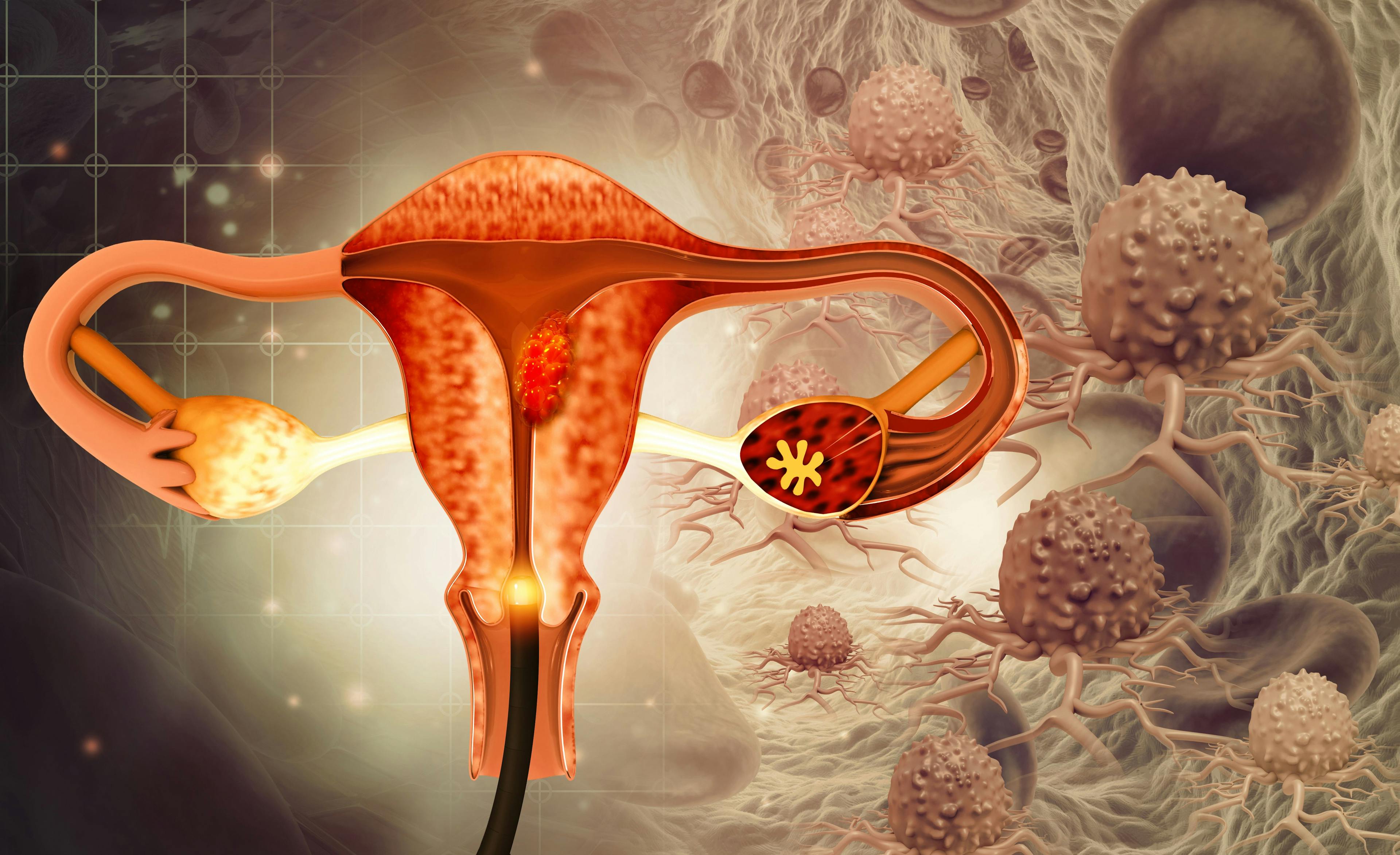 Does deep endometriosis surgery impact bladder function?