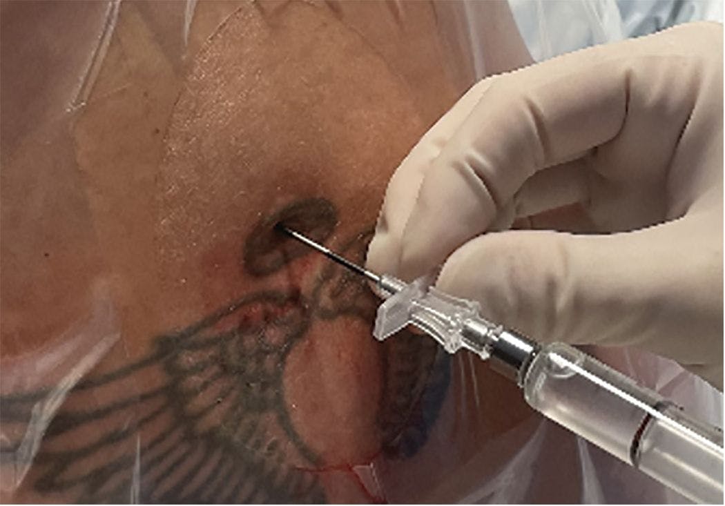 Sample image of an epidural placement with a 17-gauge Tuohy needle and attached glass syringe