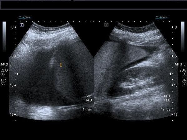 Daily Dx: Young Lady with Abdominal Pain