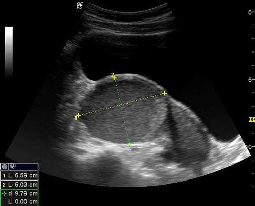Image IQ: Young Woman With Pelvic Pain