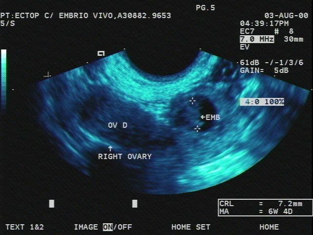 TRV Pelvis (Transvaginal) Live Ectopic Pregnancy