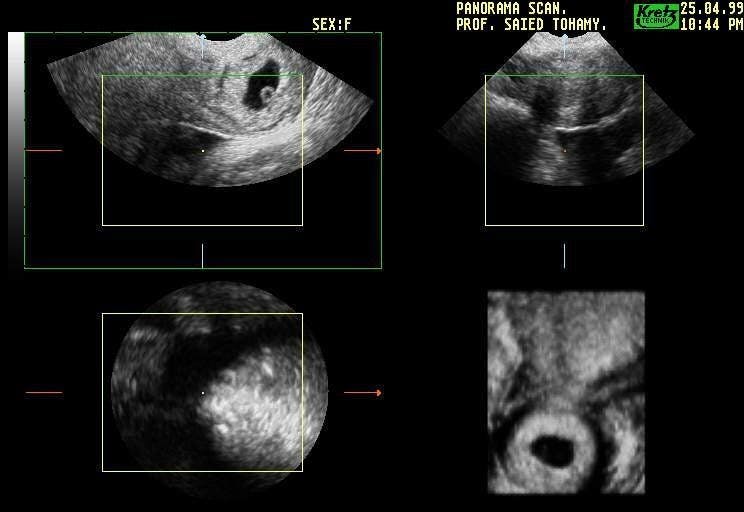 Multiplanar 3D Reconstruction Cervical Ectopic Pregnancy