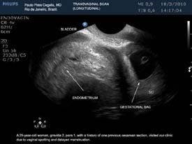Ectopic Pregnancy Within a Cesarean Delivery Scar