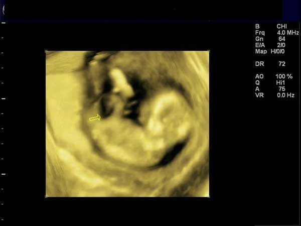 Daily Dx: A 15-Week Fetus