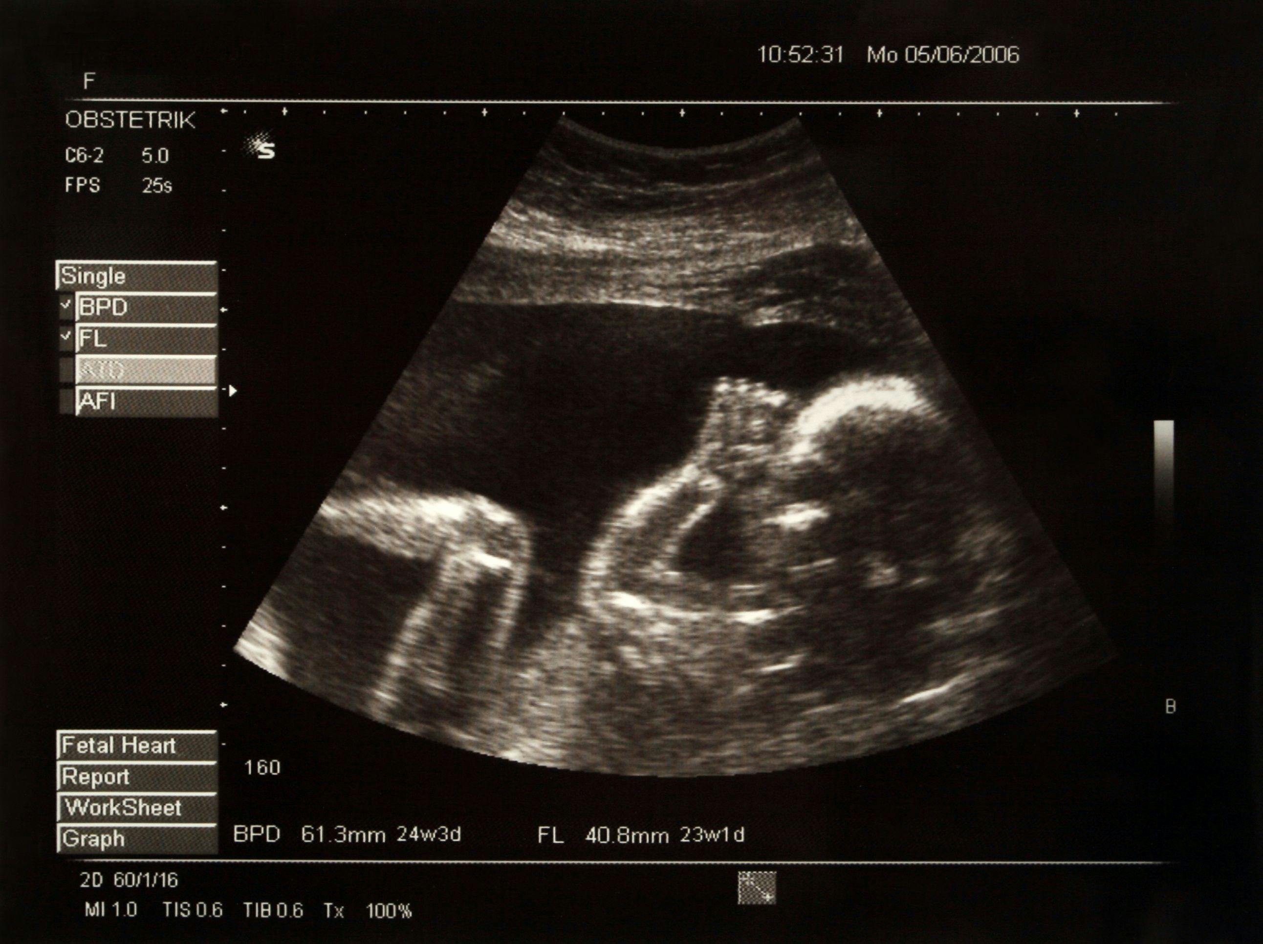 Ultrasound to predict placental pathology