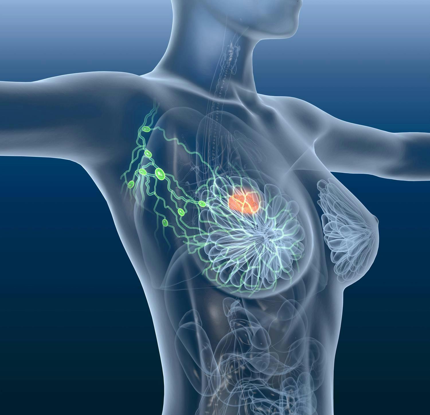  Premenopausal ER+ breast cancer recurrence reduced significantly with aromatase inhibitors