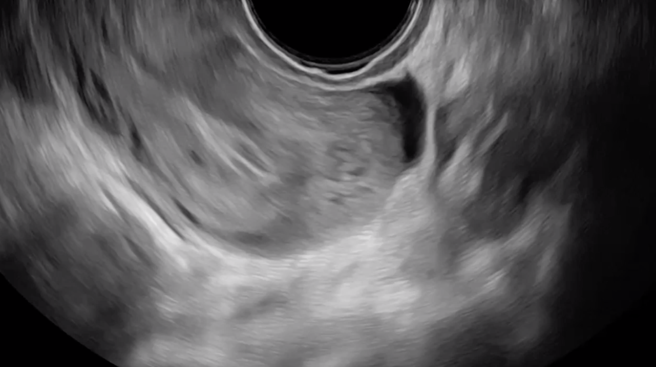Retroverted uterus, positive sliding sign
