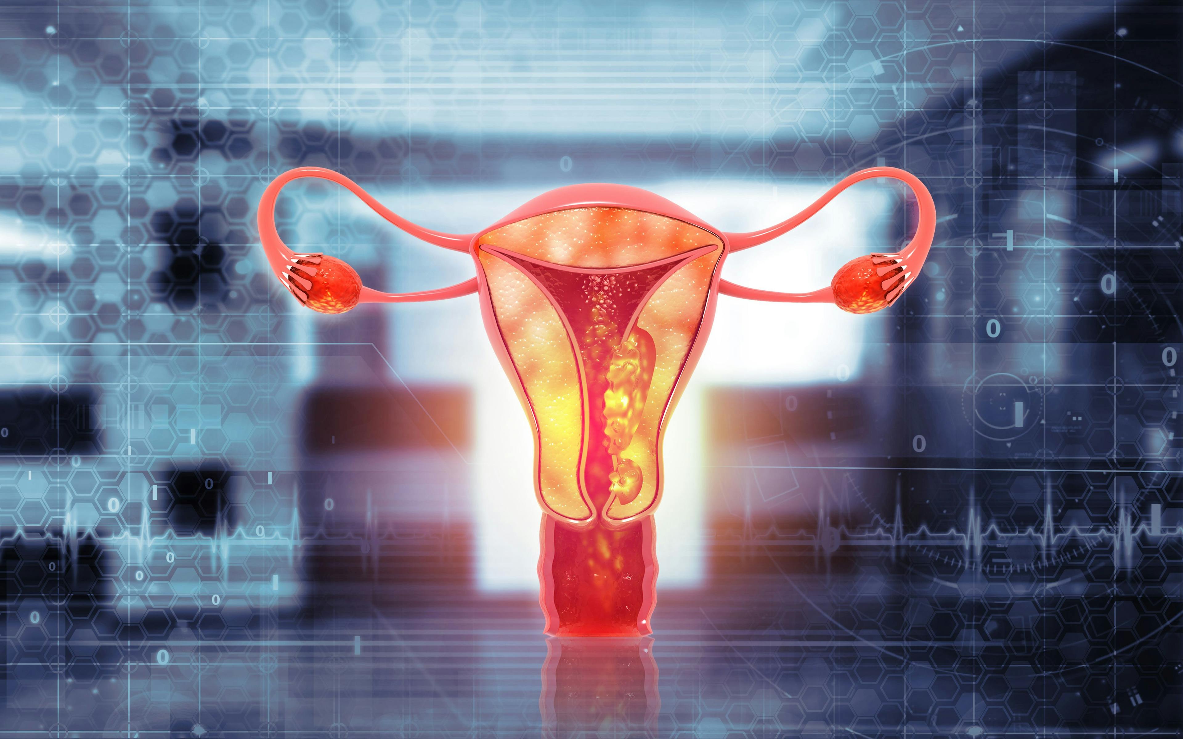 Selinexor maintenance improves PFS in endometrial cancer