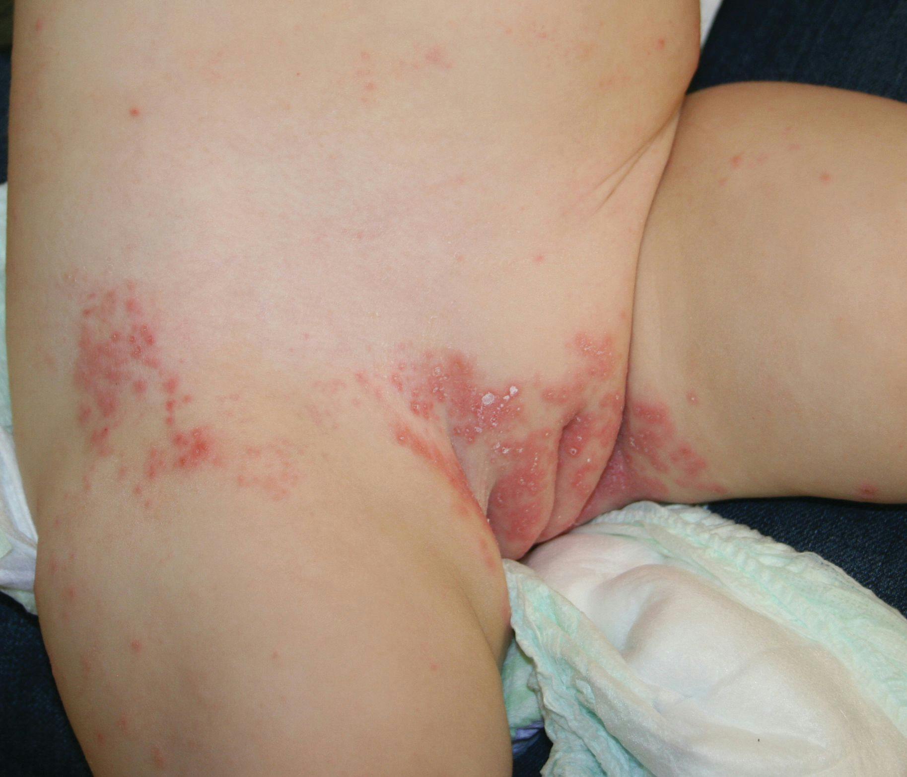 Infantile psoriasis (Image credit: Author provided)