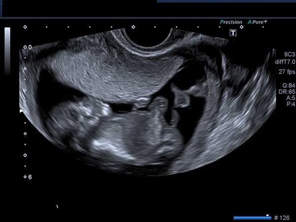 Daily Dx: A 12-Week Fetus
