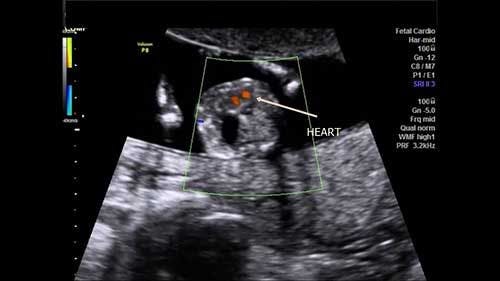 Image IQ: Fetal Abdomen in Early Second Trimester