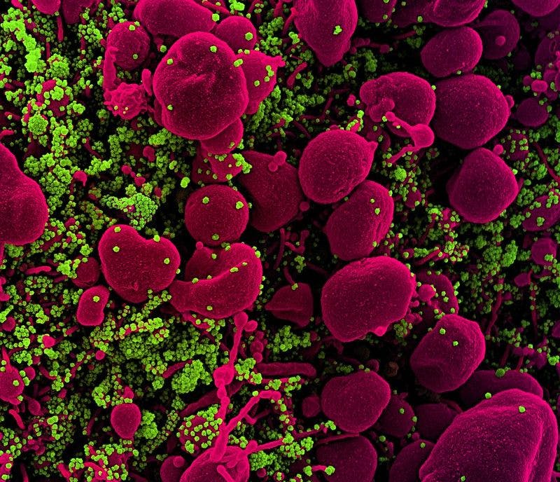 Colorized scanning electron micrograph of an apoptotic cell (pink) heavily infected with SARS-COV-2 virus particles (green), isolated from a patient sample. Image captured at the NIAID Integrated Research Facility (IRF) in Fort Detrick, Maryland.     Credit: National Institute of Allergy and Infectious Diseases/NIH