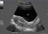 IUCD inside endometrial cavity 2D ultrasound (SAG view)