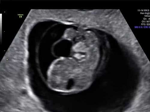 Image IQ: 8-Week Fetus