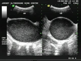 SAG and TRV Uterus Hematometrocolpos
