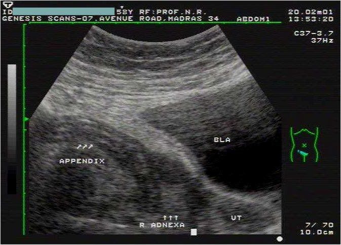 SAG RT Adnexa, Pelvic Ultrasound Incidental Finding: Appendicitis