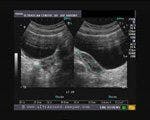 DailyDx: What is the Diagnosis of This 16 Year Olds Ovaries?