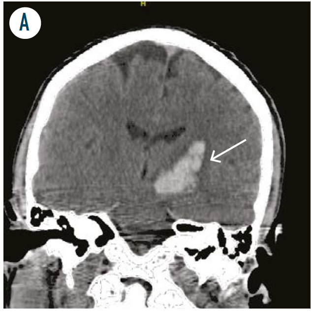 Figure 2A. Coronial CT head shows an acute intraparenchymal bleed in the left basal ganglia . (Figure author provided)