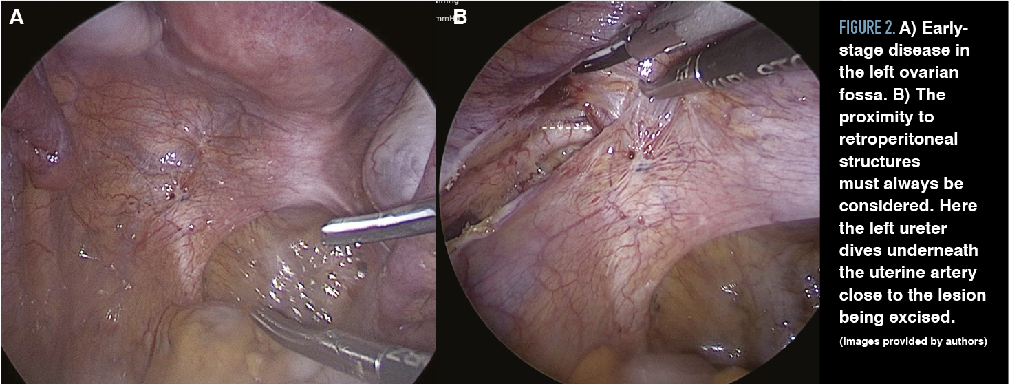 Figure 2. A) Early-stage disease in the left ovarian fossa. B) The proximity to retroperitoneal structures must always be considered. Here the left ureter dives underneath the uterine artery close to the lesion being excised. (Images provided by authors)