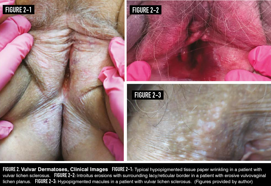 Figure 2. Vulvar Dermatoses, Clinical Images 

FIG 2-1: Typical hypopigmented tissue paper wrinkling in a patient with vulvar lichen sclerosus. FIG 2-2: Introitus erosions with surrounding lacy/reticular border in a patient with erosive vulvovaginal lichen planus. FIG 2-3: Hypopigmented macules in a patient with vulvar lichen sclerosus. (Figures provided by author)