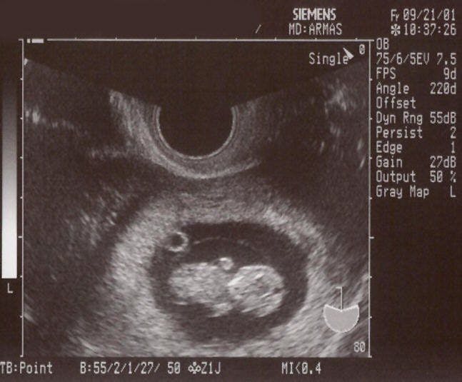 LONG Embryo (Transvaginal) 10wk Embryo and Yolk Sac