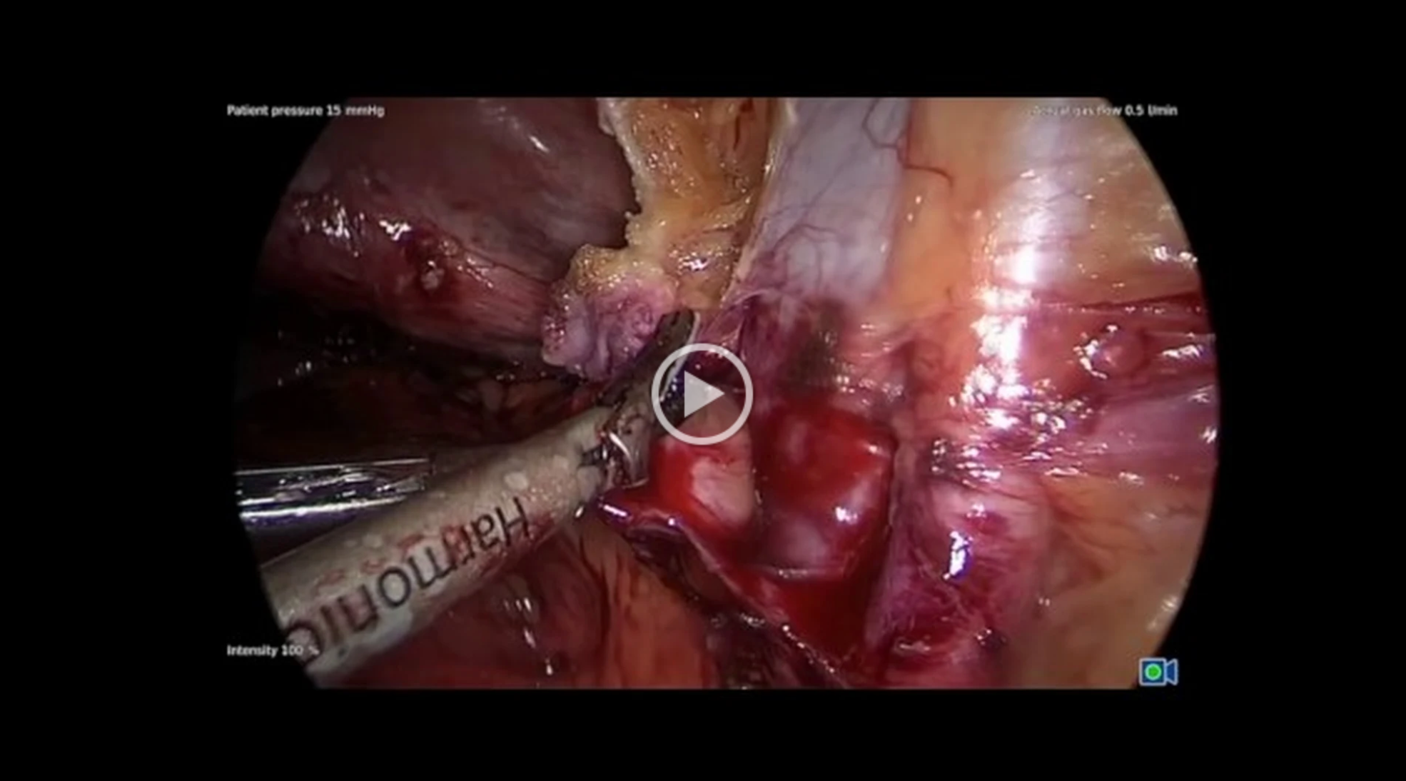 Ovarian Remnant Resection Surgery
