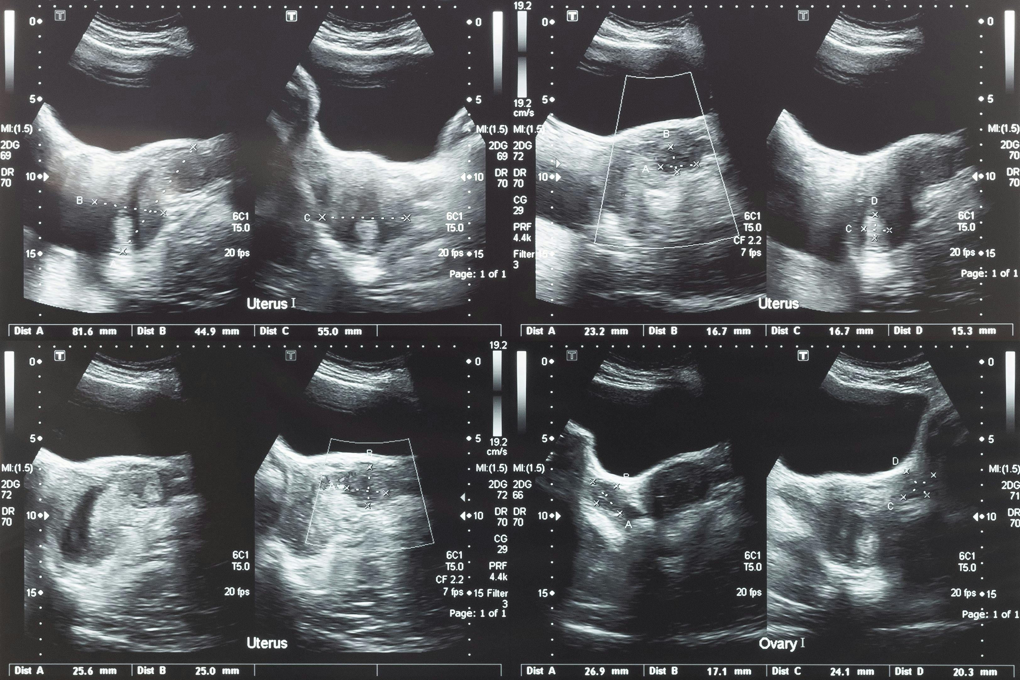 Ultrasound for uterine fibroids