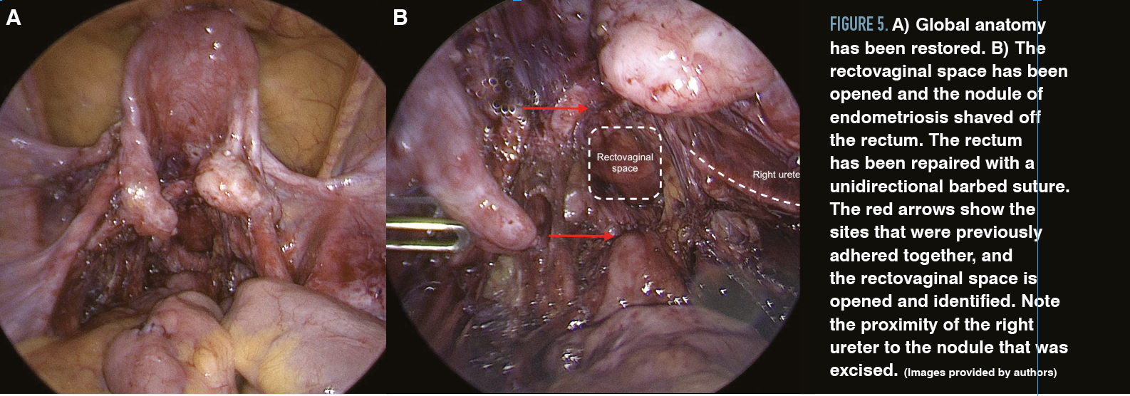 Figure 5. A) Global anatomy has been restored. B) The rectovaginal space has been opened and the nodule of endometriosis shaved off the rectum. The rectum has been repaired with a unidirectional barbed suture. The red arrows show the sites that were previously adhered together, and the rectovaginal space is opened and identified. Note the proximity of the right ureter to the nodule that was excised. (Images provided by authors)