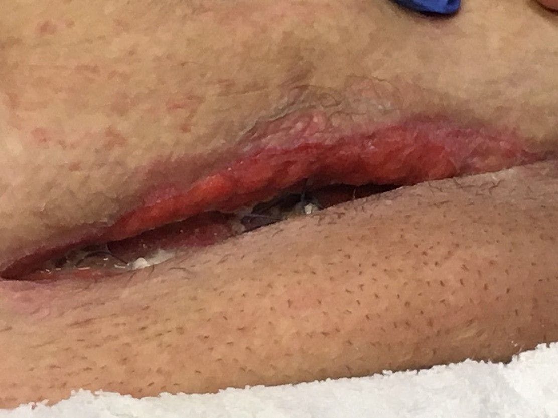 Patient incision on postoperative day 21, 8 days after beginning oral prednisone therapy