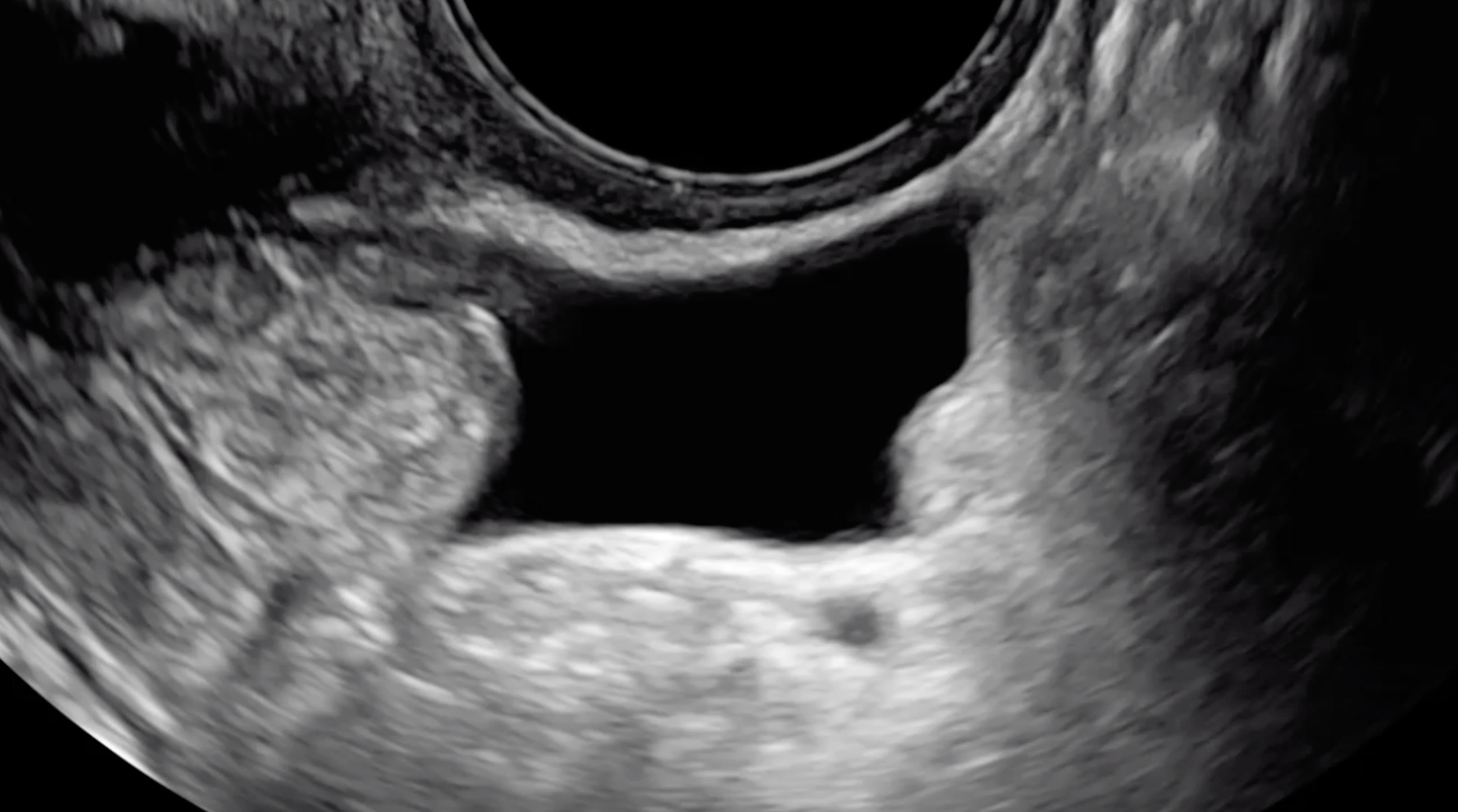 Normal uterosacral ligament and rectouterine pouch peritoneum