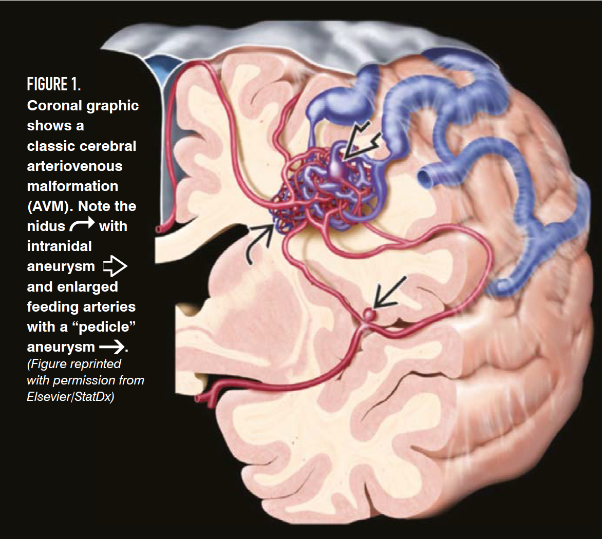Figure 1.

Coronal graphic shows a classic cerebral arteriovenous malformation (AVM). Note the nidus with intranidal aneurysm and enlarged feeding arteries with a “pedicle” aneurysm .

(Figure reprinted with permission from Elsevier/StatDx)