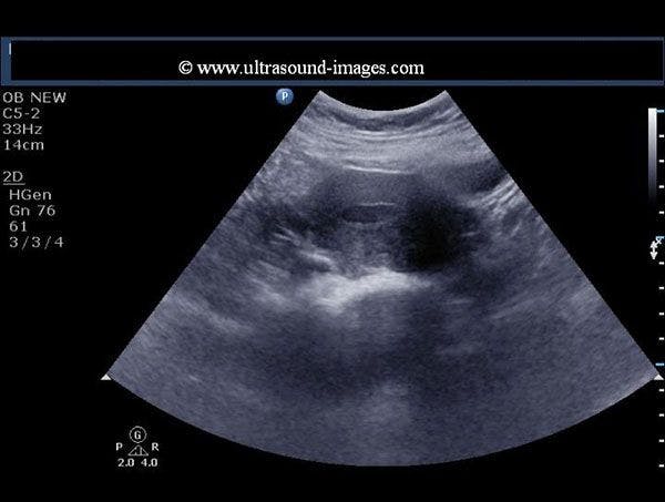 Daily Dx: 45-year-old Woman with Pelvic Pain and Vaginal Discharge