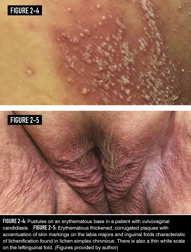 FIGURE 2-4: Pustules on an erythematous base in a patient with vulvovaginal candidiasis. FIGURE 2-5: Erythematous thickened, corrugated plaques with accentuation of skin markings on the labia majora and inguinal folds characteristic of lichenification found in lichen simplex chronicus. There is also a thin white scale on the leftinguinal fold. (Figures provided by author)