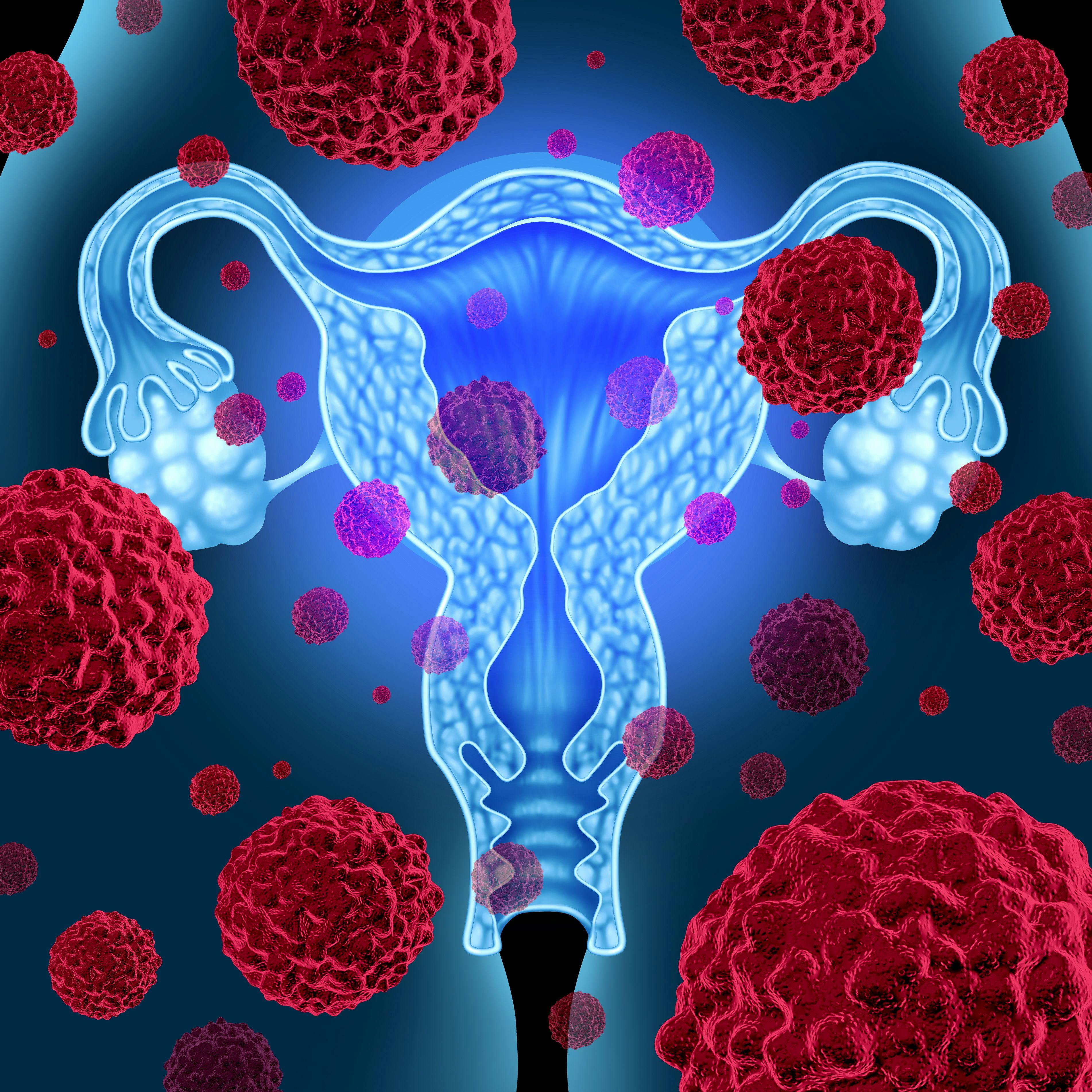Niraparib Demonstrates PFS Benefit in Chinese Population With Advanced Ovarian Cancer