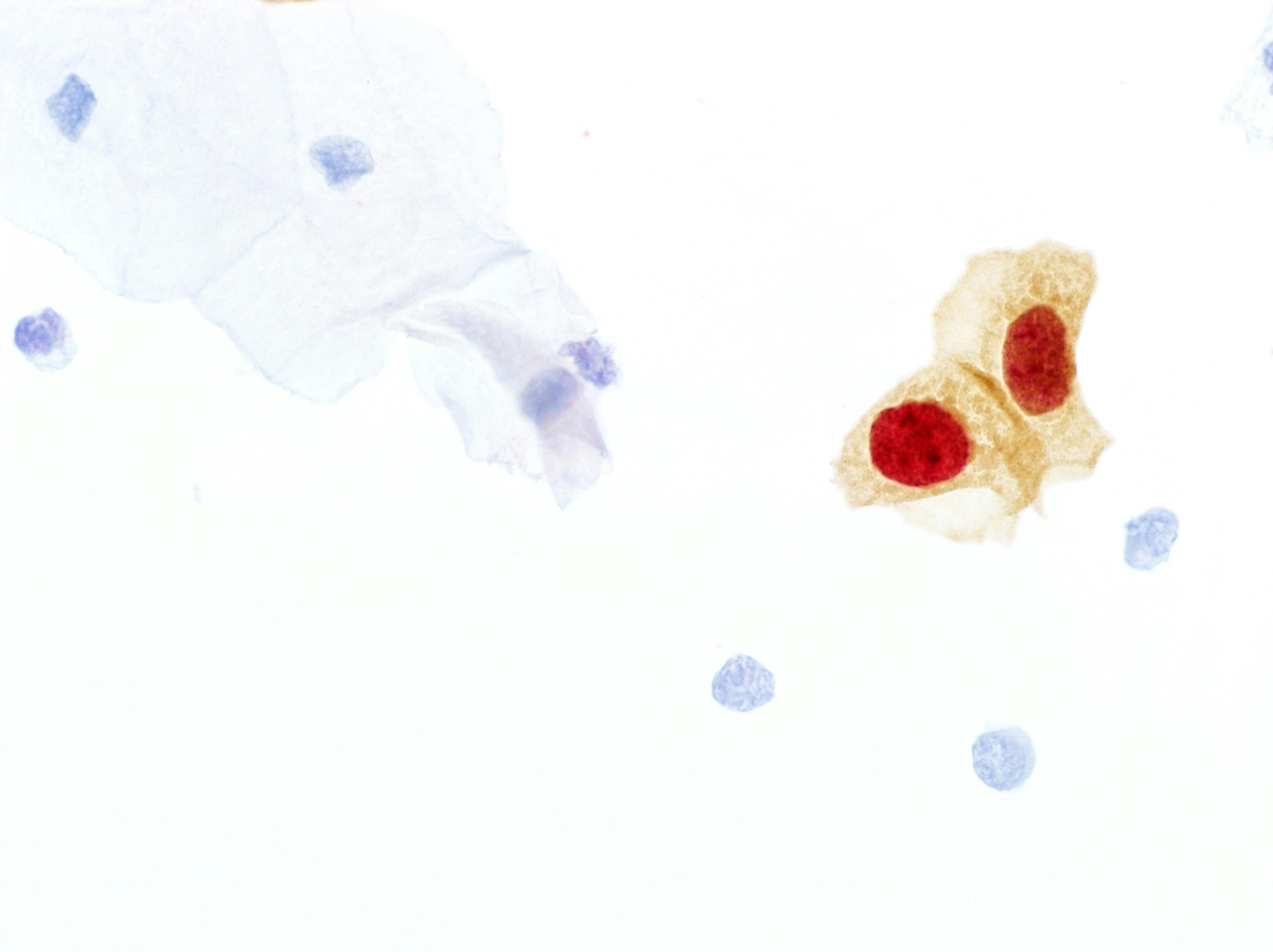 Positive CINtec PLUS Cytology test results, dual staining of the biomarkers p16 and Ki-67. Microphotograph courtesy of Roche. 