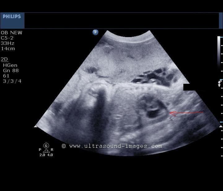 Daily Dx: A Fetal Heart Quiz